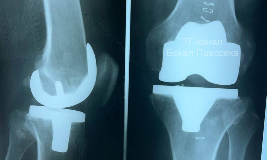 Первое эндопротезирование коленного сустава провели в нижегородской ГКБ №13 - фото 1